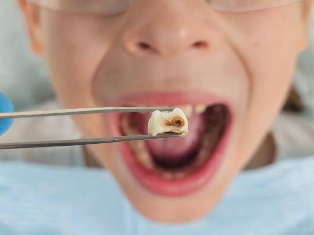 Best Urgent Care for Lost Fillings or Crowns in Muldrow, OK